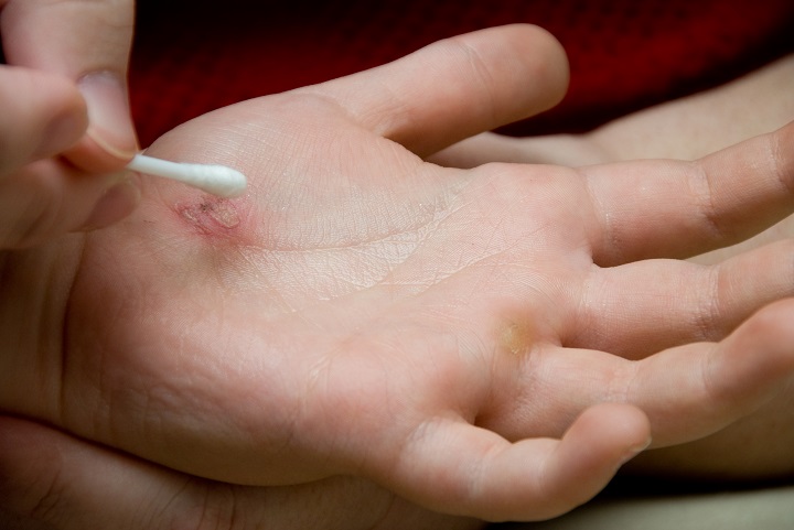 An injury on the hand of a child.